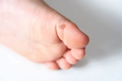 Illustration-of-plantar-warts-in-a-pedia-foot.