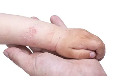Baby skin with rashes