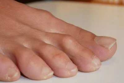 Illustration of hammertoes on a persons foot