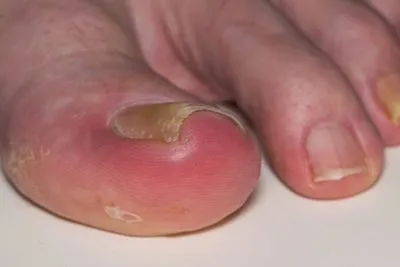 Illustration of ingrown toenail on foot
