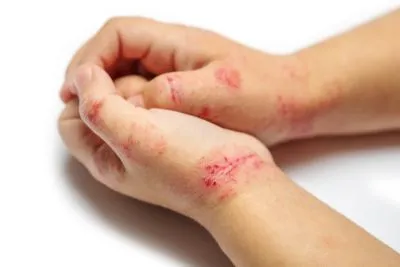 Kids eczema on hand
