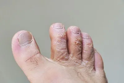 Close-up of foot showing signs of athlete’s foot infection