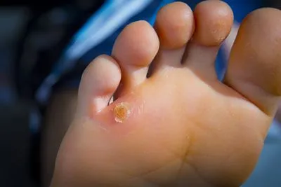 Close-up image of corns on human foot
