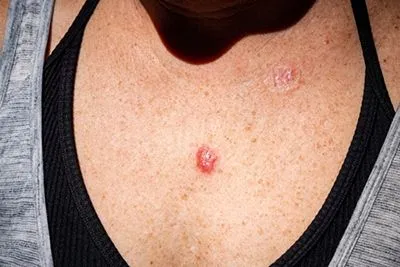 Basal Cell Treatment in Beverly Hills, CA