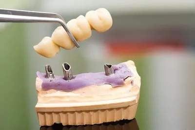 Dental Implants - Dentist Chester and Hackettstown NJ