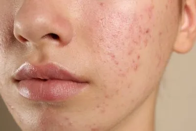 Acne scars on face of a woman.