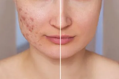 Acne treatment before and after results