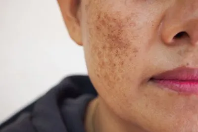 Woman with age spot on her face.