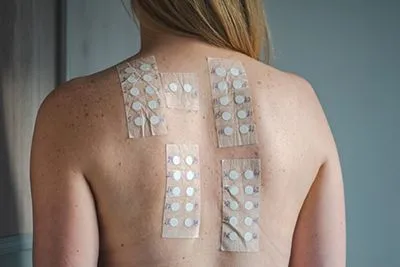 Allergy patch test applied to woman’s back to identify contact allergens