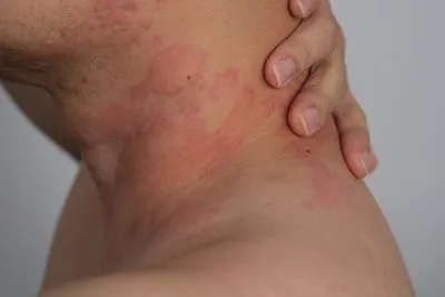 Man showing signs of neck rash due to skin allergy