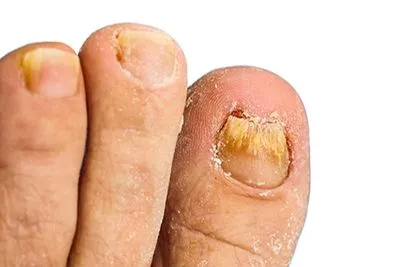 Toenail Fungus