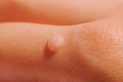 close up image of skin warts in boise idaho