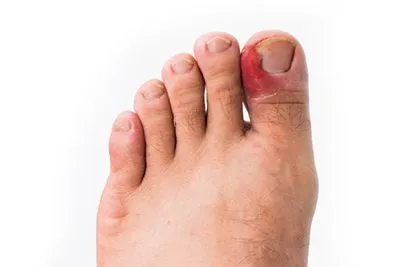 Ingrown Toenails