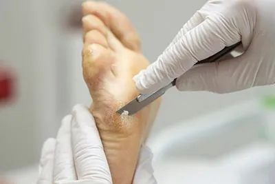 Podiatrist carefully removing a callus from a patient’s foot in a clinical setting.