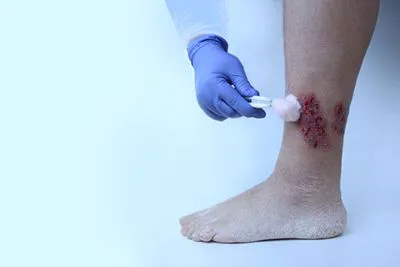 Podiatrist cleaning and dressing a wound located above the patient’s ankle