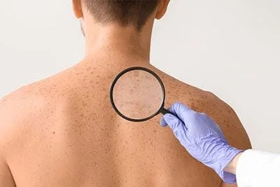 skin cancer treatments
