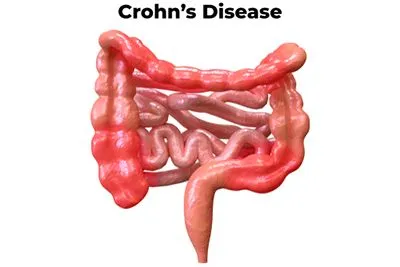 Crohns-Disease-Causes-Inflammation in-Your-Gastrointestinal-System-Resulting-in-Painful-Debilitating-Symptoms