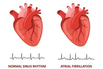 Normal sinus rhythm and atrial fibrillation rhythm