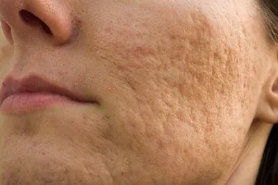 Acne-Scars-Treatment-in-Memphis-Collierville-and-Jackson-TN