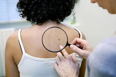 Skin Cancer Screenings