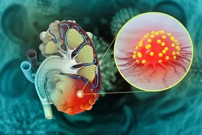 Polycystic Kidney Diseases