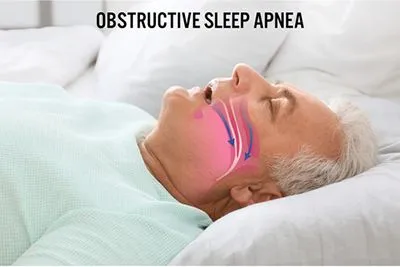 Obstructive Sleep Apnea