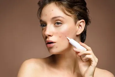 Acne Treatment in Wesley Chapel