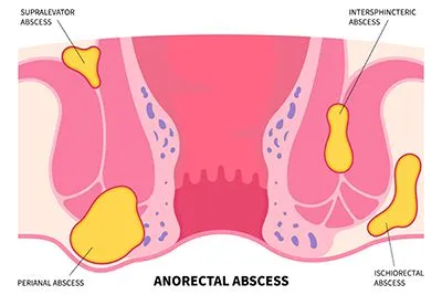 Illustration of Anal Abscess in 2D graphics