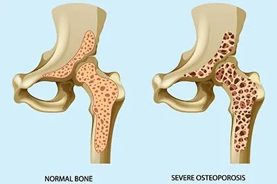 Medical illustration comparing normal bone density and osteoporosis