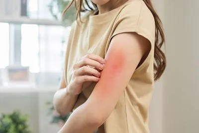 Rashes-Treatment-in-Sarasota-FL