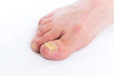 Fungal-Nails-in-Viera-FL