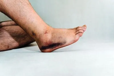 Ankle sprain showing visible bruising and swelling