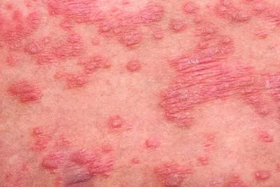 Close-up-Picture-of-Psoriasis