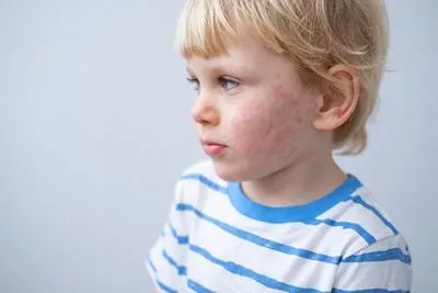 Child with skin rash on cheek