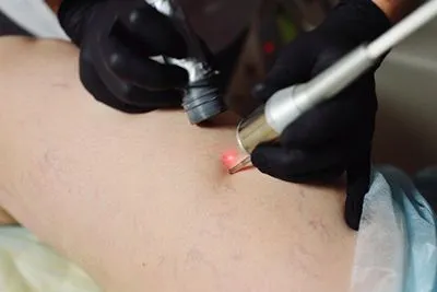 Close-up of laser procedure targeting spider veins on leg