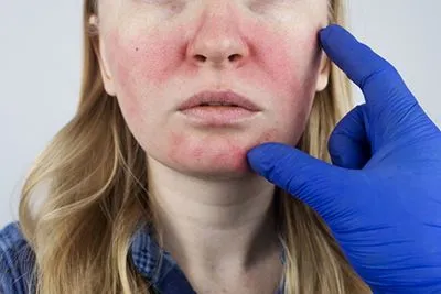 Rosacea-Treatment-in-Greenville-and-Easley-SC