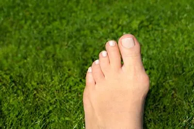 Close-up of foot showing bunion deformity on natural grass background