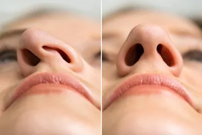 Before and after results of deviated septum correction through reconstructive surgery