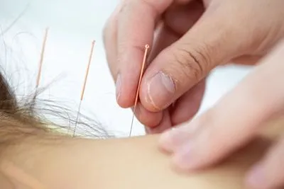 Patient receiving acupuncture treatment for neck pain relief