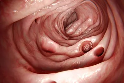 Diverticulitis-Treatment-in-Portland-OR