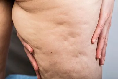 Cellulite-Treatment-in-Palm-Coast-Ormond-Beach-and-Port-Orange-FL