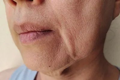 Sagging-Skin-in-Palm-Coast-Ormond-Beach-And-Port-Orange-FL