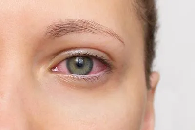 Woman with irritated eye caused by dry eyes
