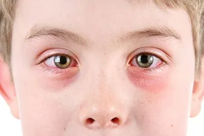 Child with red, watery eye affected by conjunctivitis.