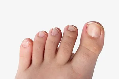 Ingrown-Toenail-Treatment-in-Yarmouth-ME-Serving-Portland-ME