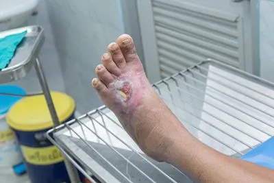Patient with diabetic foot ulcer undergoing preparation for wound treatment.