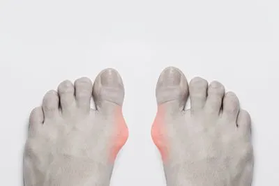 Person with Bunions conditions