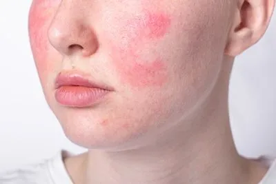 Rosacea-Treatment-in-Grosse-Pointe-Woods-New-Baltimore-and-Hartland-MI