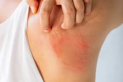 Illustration of fungal infection on back of skin