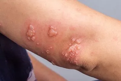 Close-up of shingles (herpes zoster) rash on woman's elbow